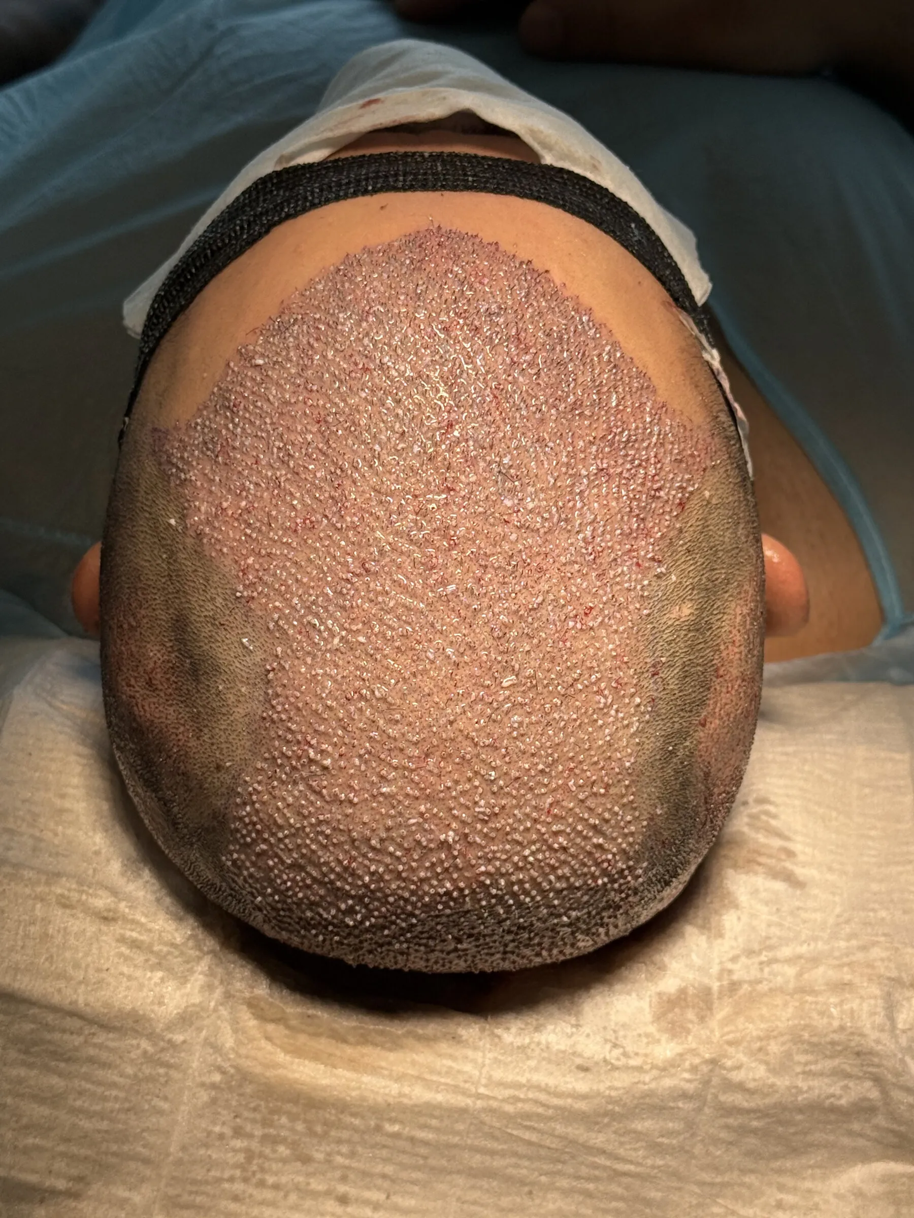 Nahaufnahme des Empfängerareals unmittelbar nach der Graft-Platzierung während einer echten Haartransplantation bei der AS Clinic Berlin